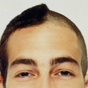 no-shave-transplantatie